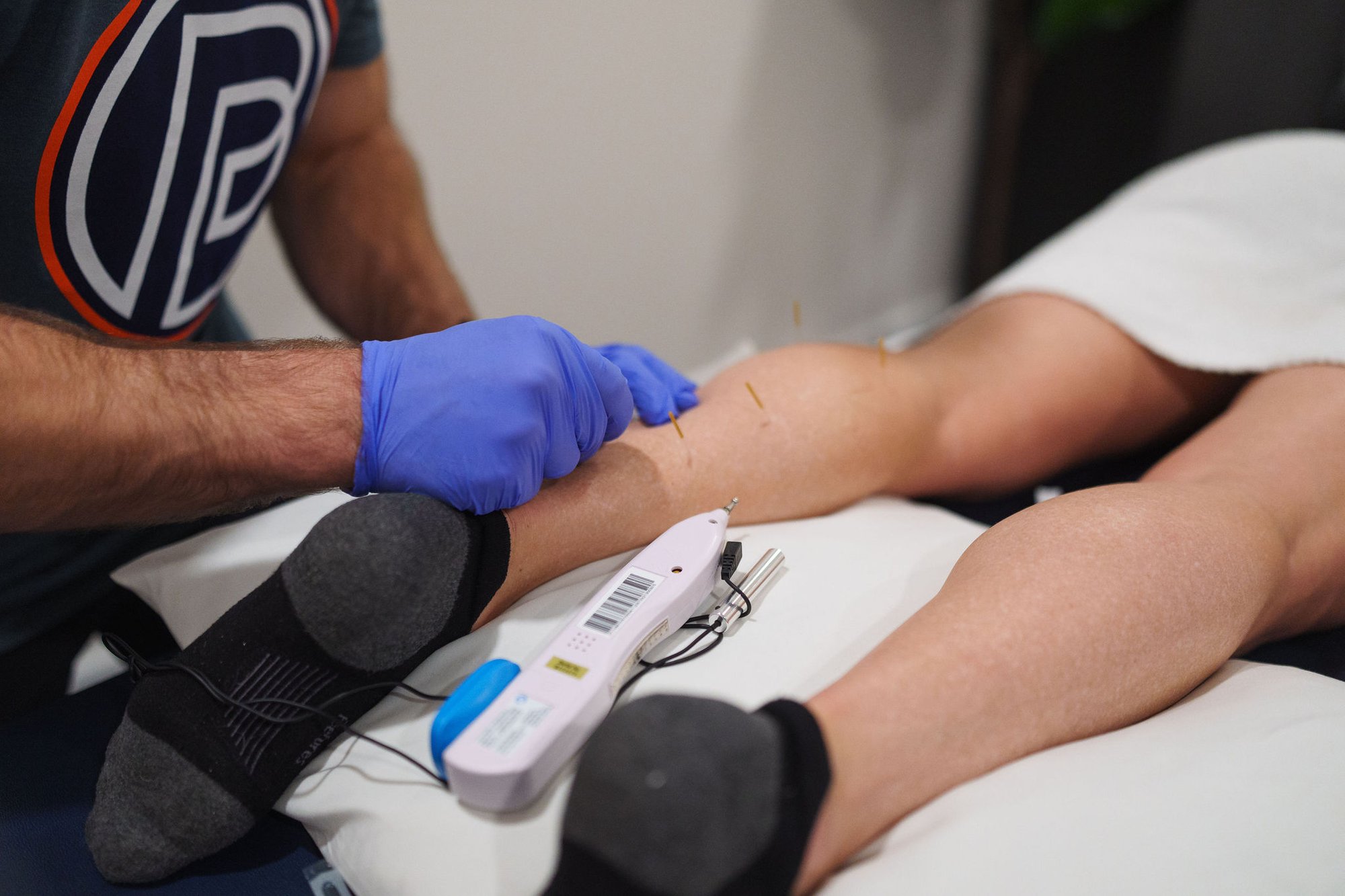 dry needling physical therapy