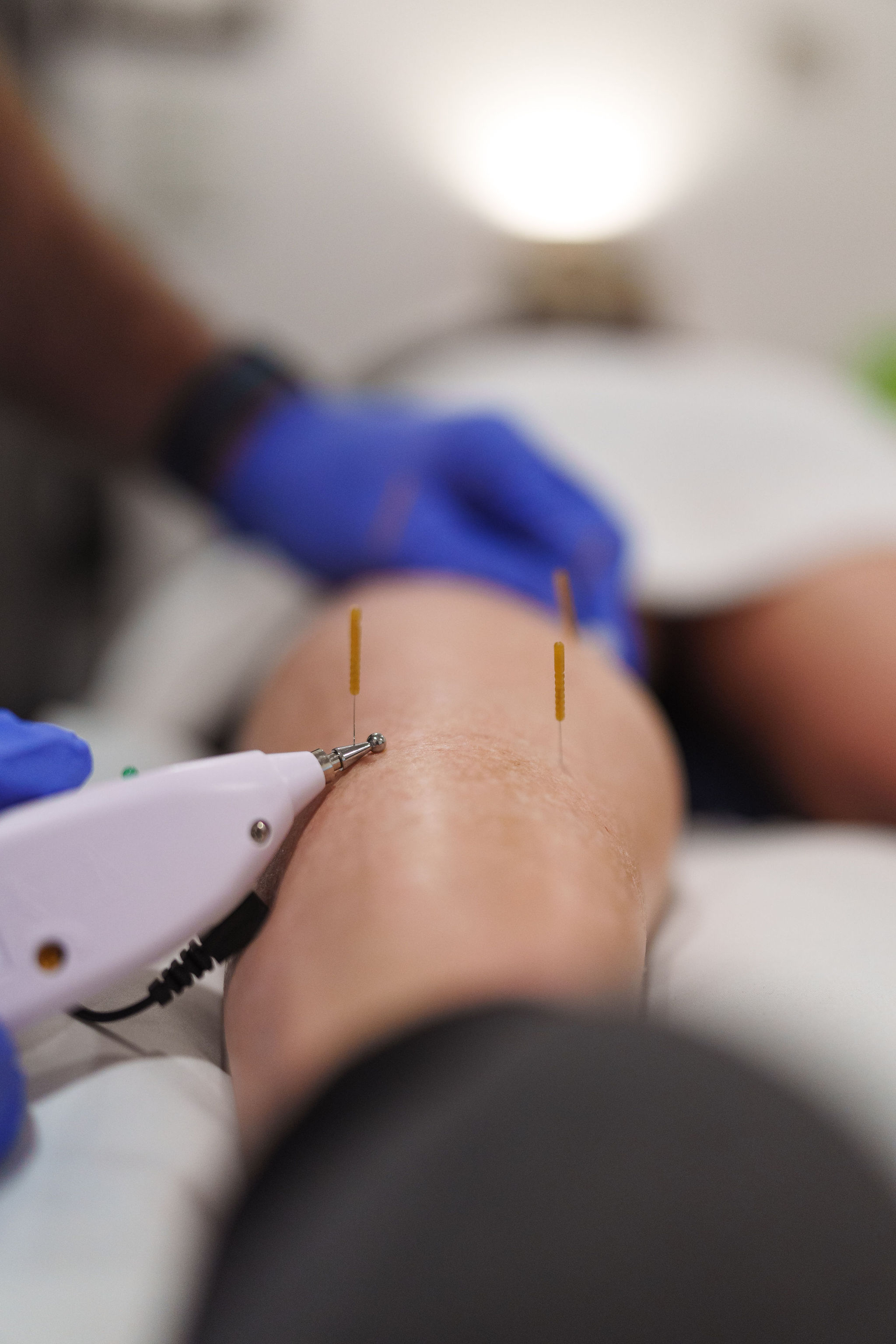 dry needling